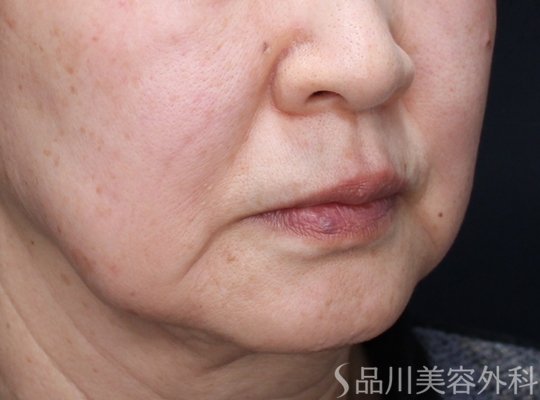 症例NO.73764のBEFORE写真