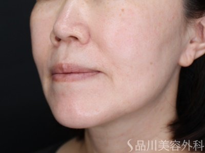 症例NO.72315のBEFORE写真