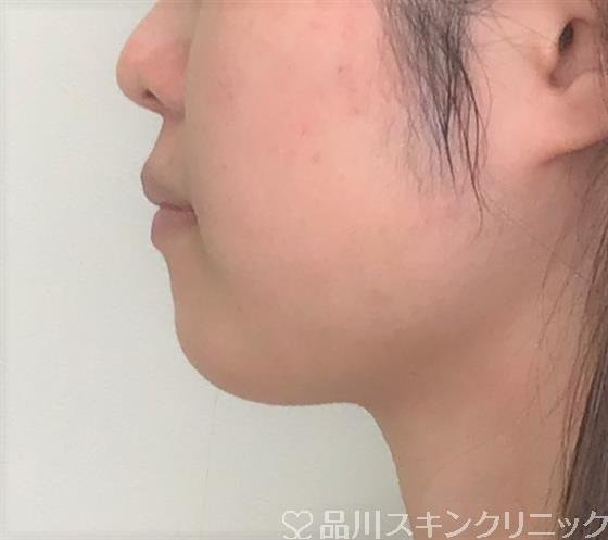 症例NO.55436のAFTER写真