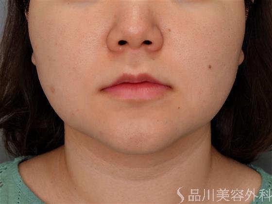 症例NO.55083のBEFORE写真