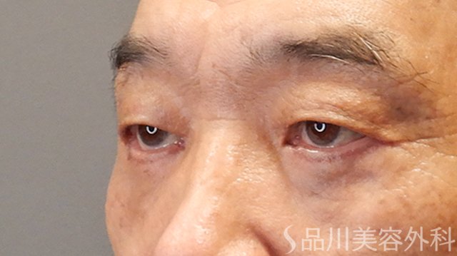 症例NO.75223のAFTER写真