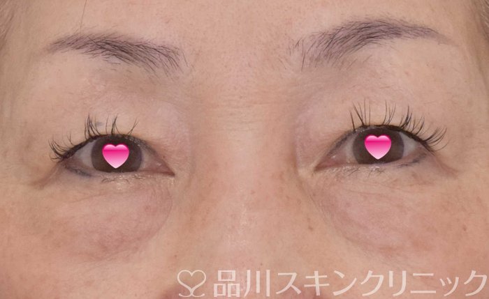 症例NO.69172のBEFORE写真