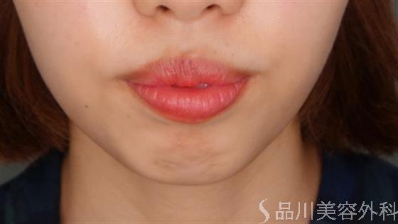 症例NO.52312のBEFORE写真