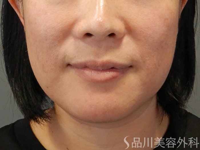症例NO.71449のBEFORE写真