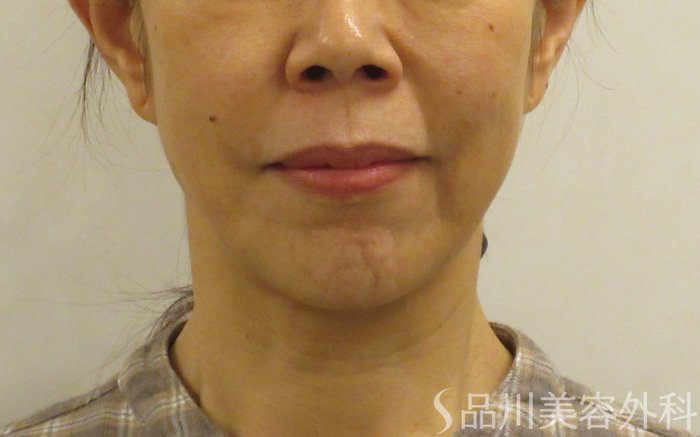 症例NO.67847のBEFORE写真