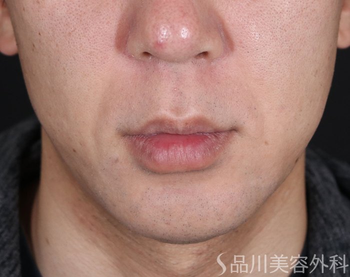 症例NO.74274のBEFORE写真