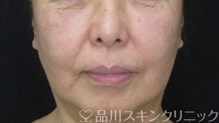 症例NO.71997のAFTER写真