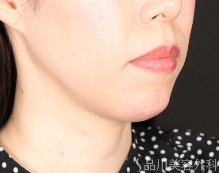 症例NO.71031のAFTER写真