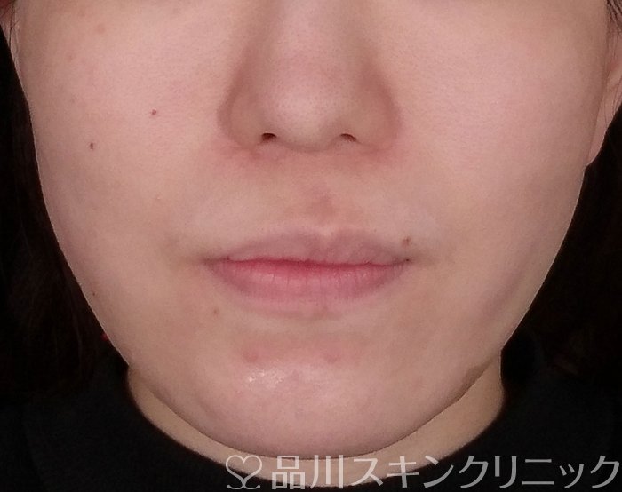 症例NO.69809のAFTER写真