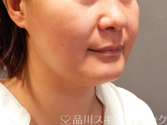 症例NO.70314のAFTER写真