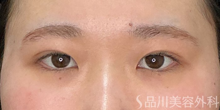 症例NO.73242のAFTER写真