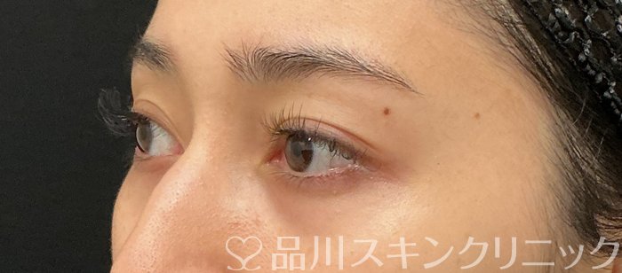 症例NO.74155のBEFORE写真