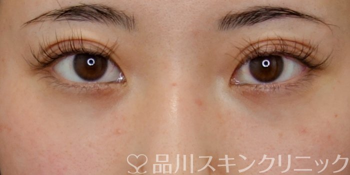 症例NO.74048のAFTER写真