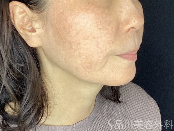 症例NO.67881のBEFORE写真