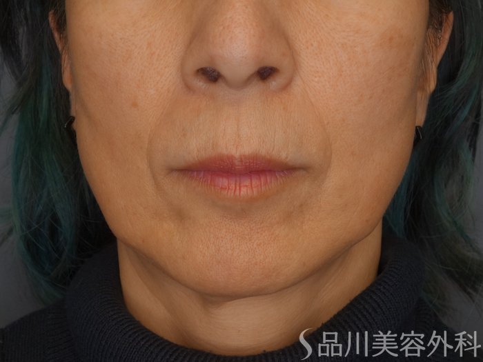 症例NO.67832のBEFORE写真