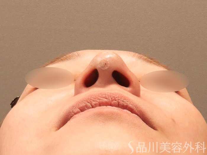 症例NO.70922のAFTER写真