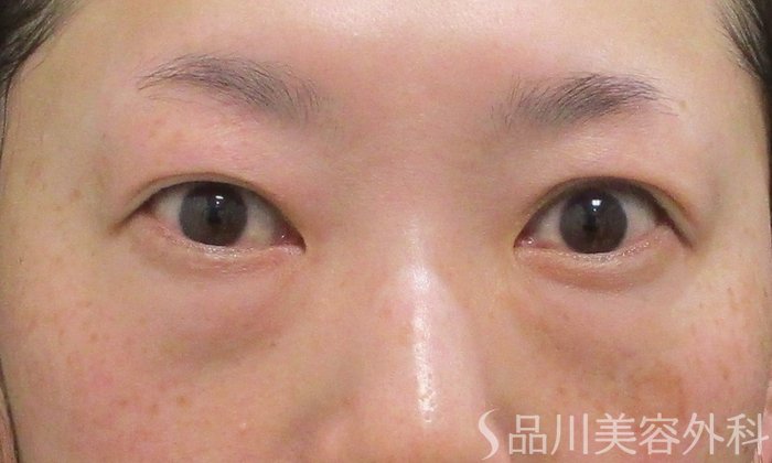 症例NO.69796のBEFORE写真