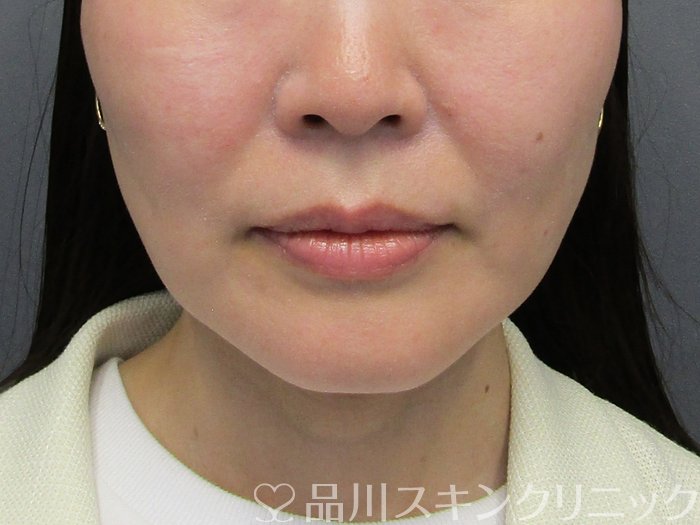 症例NO.75119のBEFORE写真