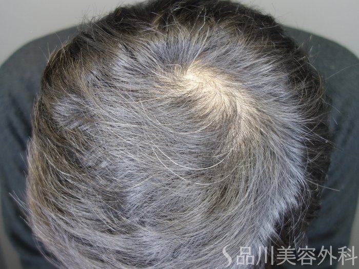症例NO.75323のBEFORE写真