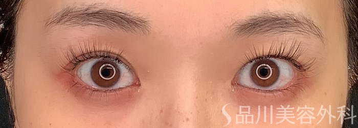 症例NO.67985のBEFORE写真