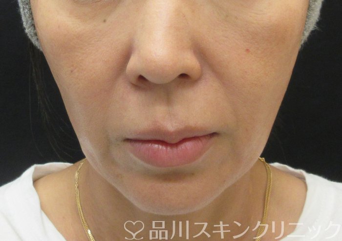 症例NO.74100のBEFORE写真