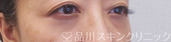症例NO.71049のAFTER写真