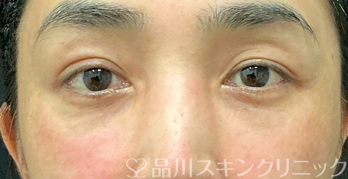 症例NO.75199のBEFORE写真