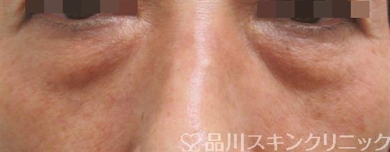 症例NO.25754のBEFORE写真