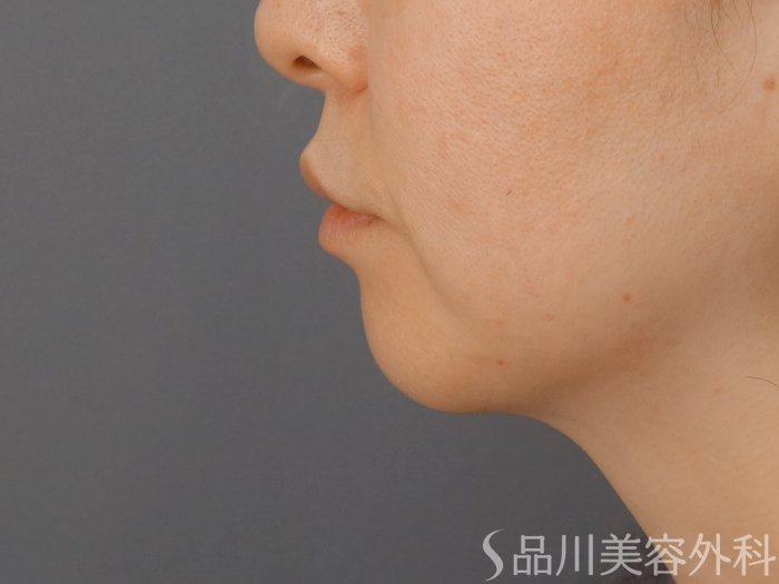 症例NO.72611のBEFORE写真