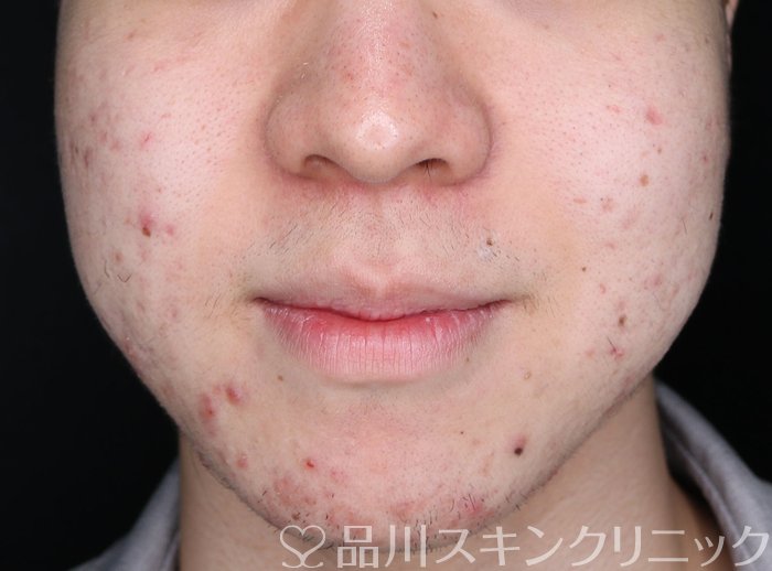症例NO.69197のBEFORE写真