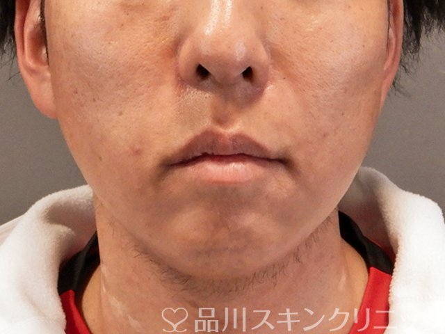 症例NO.70490のAFTER写真