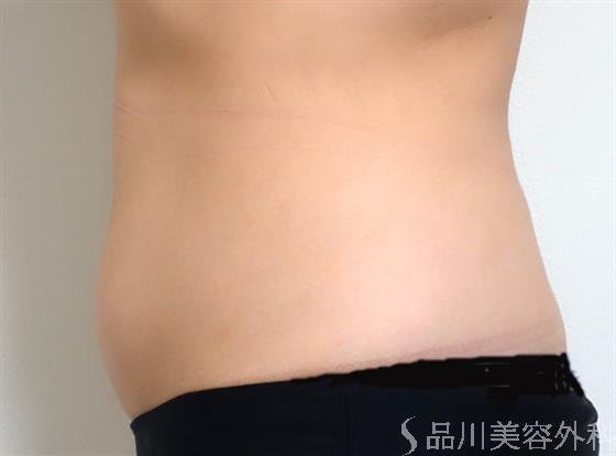 症例NO.35165のAFTER写真