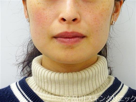 症例NO.45200のAFTER写真