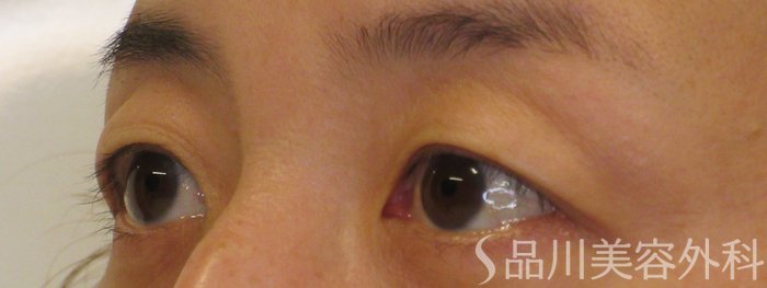 症例NO.70827のBEFORE写真