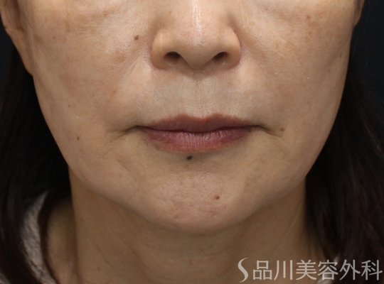 症例NO.75105のAFTER写真