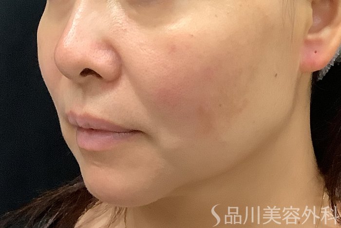 症例NO.71245のBEFORE写真