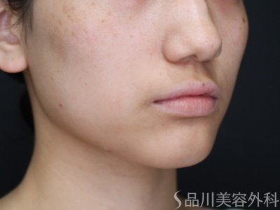 症例NO.71914のBEFORE写真