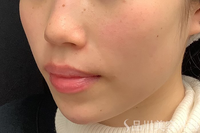 症例NO.69642のAFTER写真