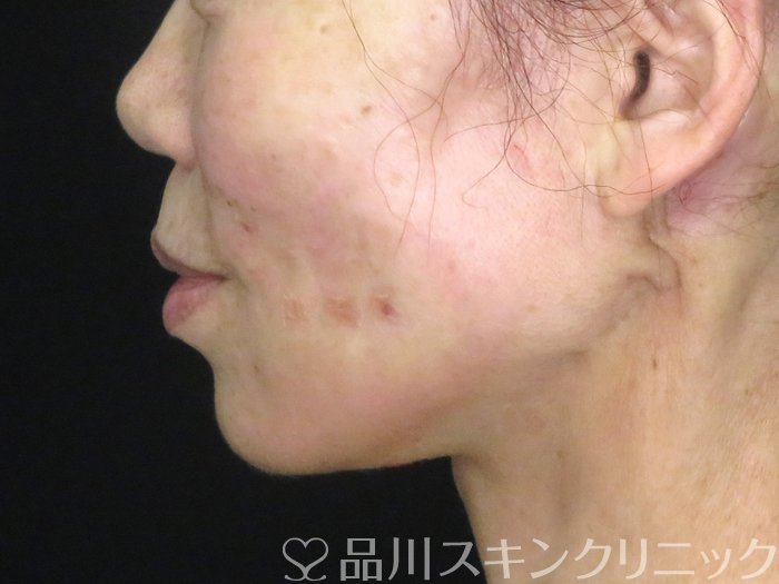 症例NO.70580のAFTER写真