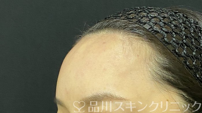 症例NO.74663のAFTER写真