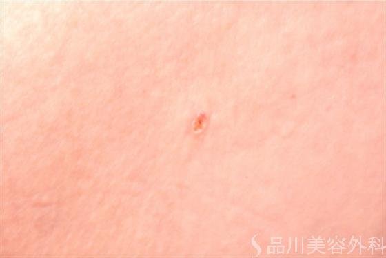 症例NO.13307のAFTER写真