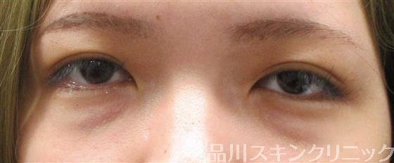 症例NO.61029のBEFORE写真