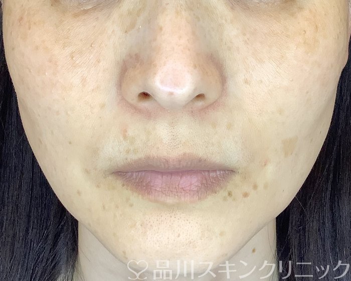 症例NO.67176のAFTER写真