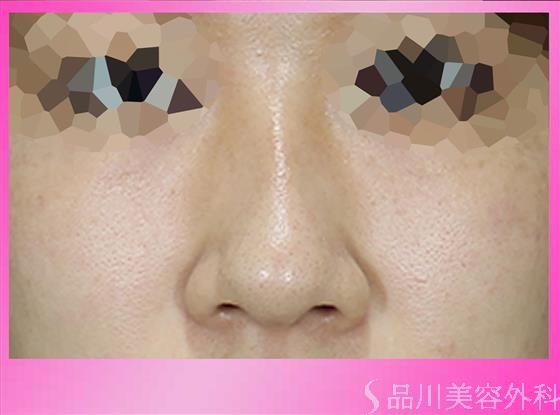 症例NO.48670のBEFORE写真