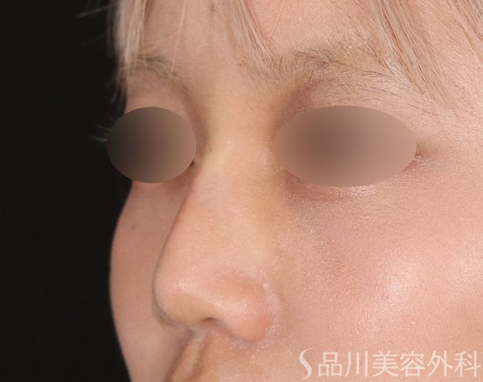 症例NO.71540のAFTER写真