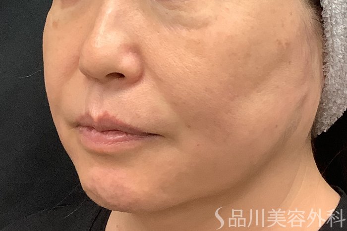 症例NO.71251のAFTER写真