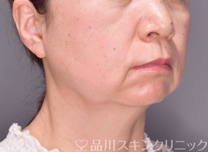 症例NO.69420のBEFORE写真