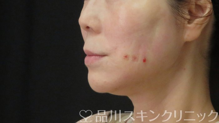 症例NO.72886のAFTER写真