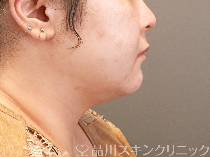 症例NO.66541のAFTER写真