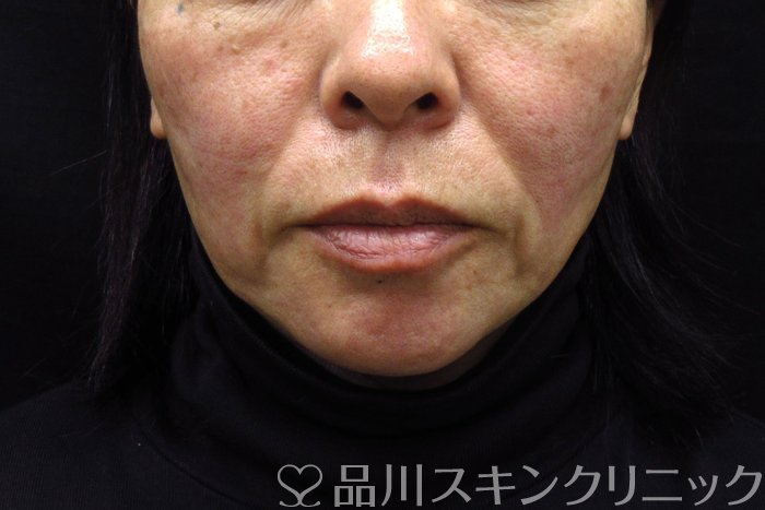 症例NO.74618のBEFORE写真